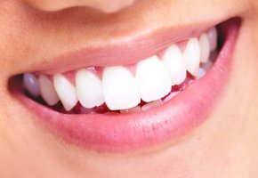 Carillas dentales para mejorar su sonrisa