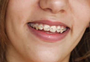 Ortodoncia invisible: Fija y removible